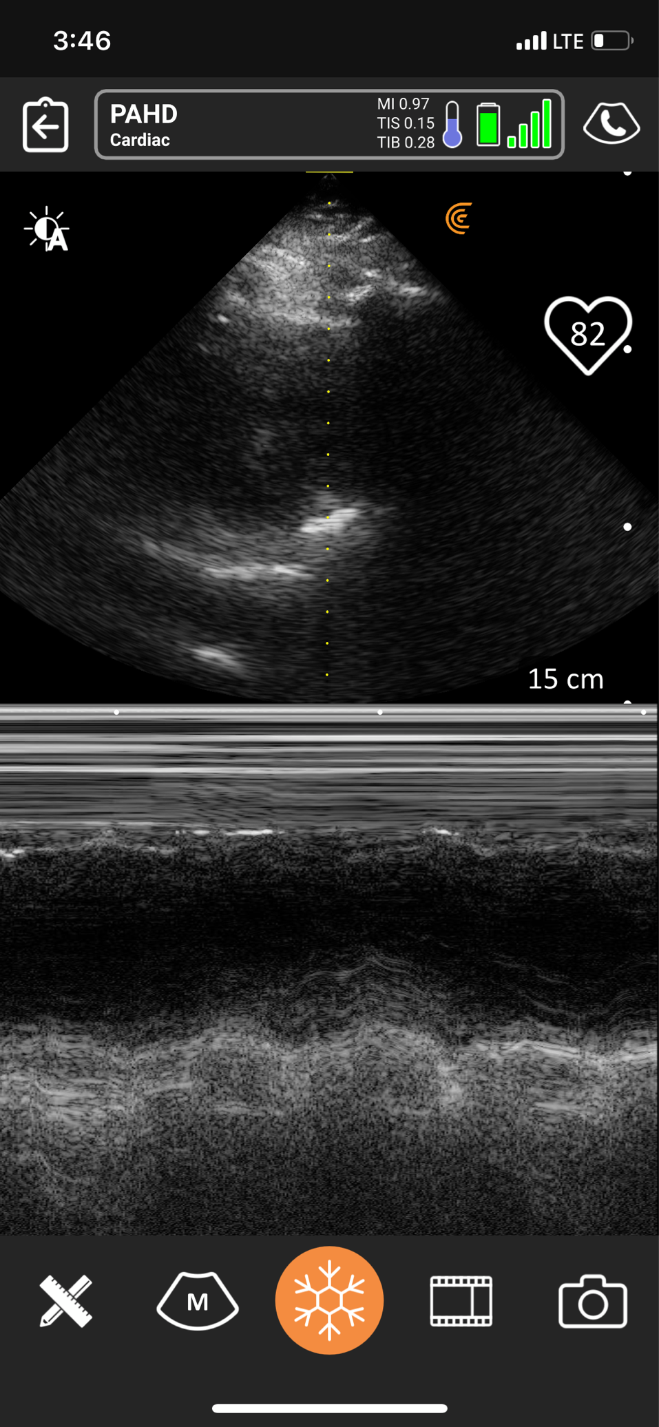 Measuring Heart Rate In B-Mode, M-Mode Or In Pulsed Wave – Clarius Support